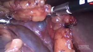 Лапароскопическое иссечение кисты почки