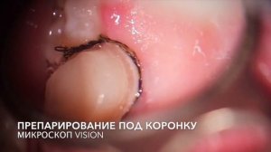 Препарирование под коронку