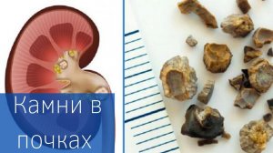 КАМНИ В ПОЧКАХ | Как лечить? | Профилактика