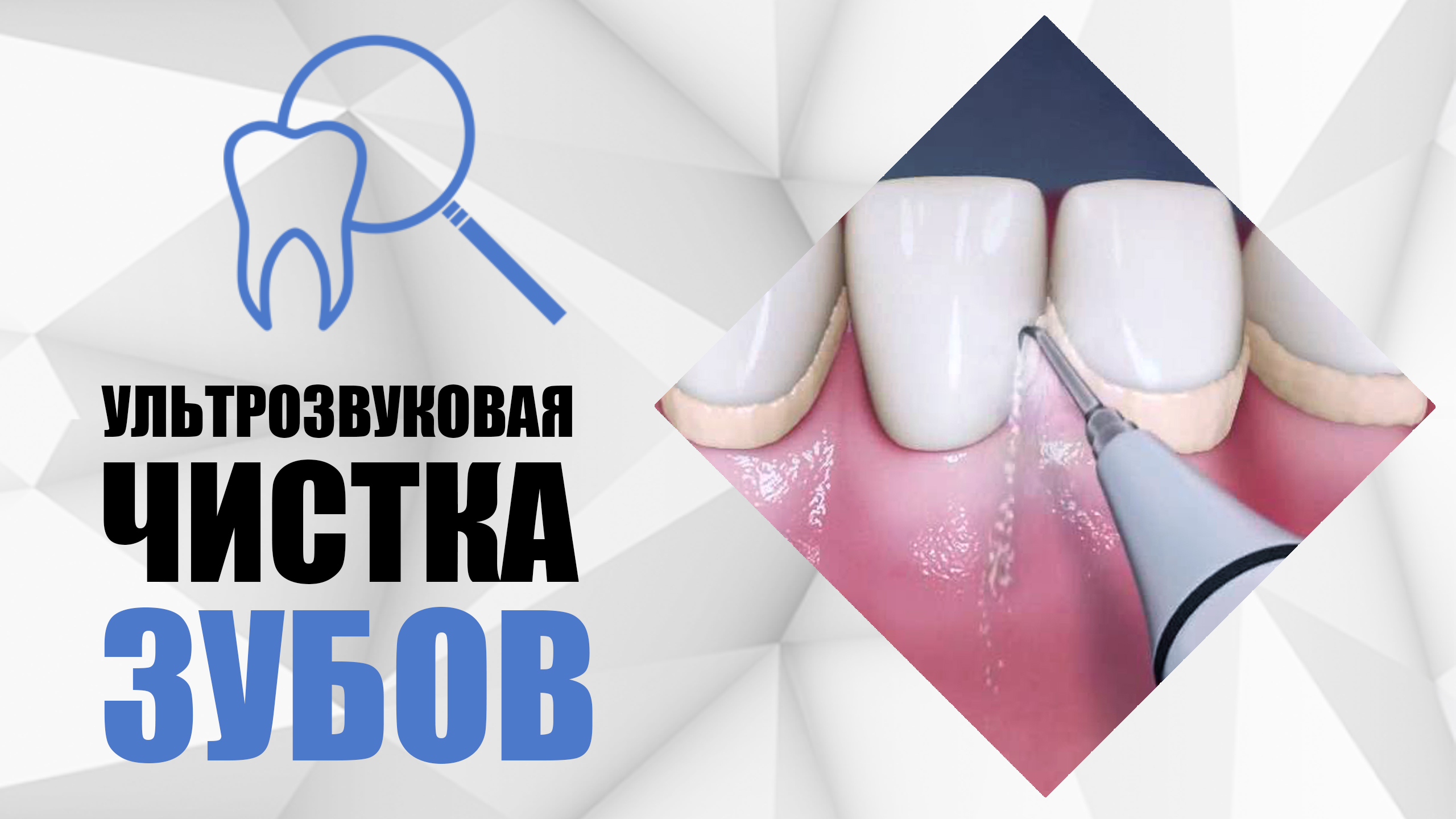 Ультразвуковая чистка зубов [ чистка зубов от камней и твердого пигментированного налета ].