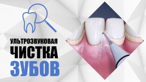 Ультразвуковая чистка зубов [ чистка зубов от камней и твердого пигментированного налета ].