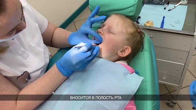 Фиксация аппарата Марко Росса / Исправление прикуса у детей