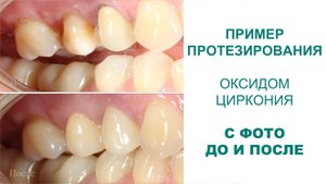 Пример протезирования коронками оксида циркония
