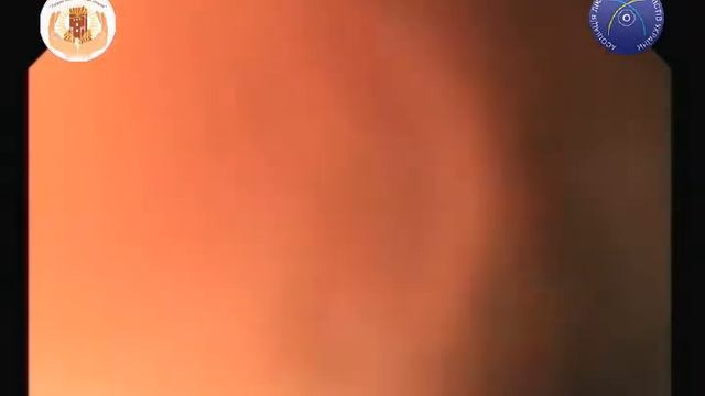 15 Післявиразковий рубець цибулини ДПК смотреть онлайн