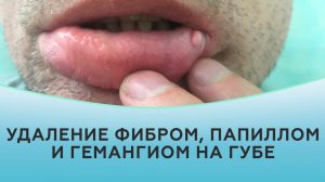 Удаление фибром, папиллом и гемангиом на губе.