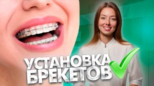 Больно ли устанавливать брекет-систему? Брекеты. Ортодонт. Стоматология.