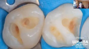 Бесплатный вебинаров "Реставрация на жевательный зубы" от Ивана Казадаев