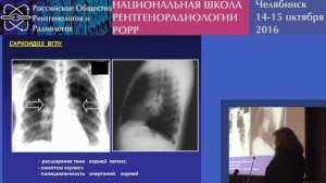 И.А. Соколина - Саркоидоз органов дыхания