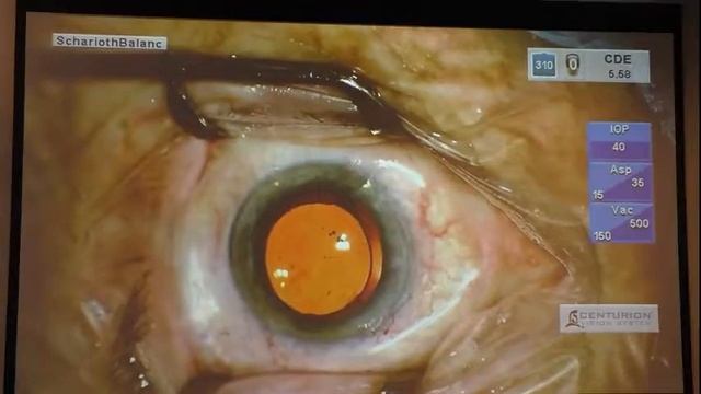Факоэмульсификация на Centurion с имплантацией торической ИОЛ Acrysof Restor смотреть онлайн