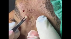 Удаление черных точек 2021 - Remoção de cera de ouvido 2022 EP009