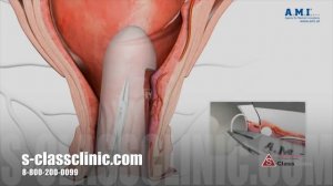 HAL RAR в лечении геморроя