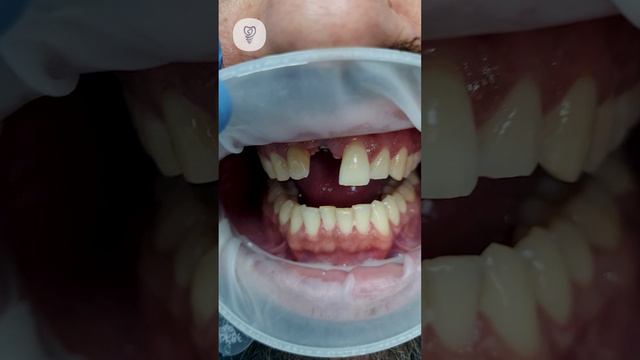 Передние зубы — это лицо улыбки. Вернули пациенту эстетику и красоту. Имплантация Зубов. Первая стом