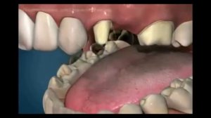 Мостовидный зубной протез