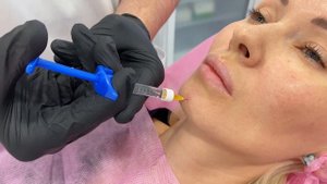 Коррекция подбородка и гармонизация лица филлерами в INNOVATION Clinic