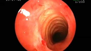 Трахеоскопия при рубцовом стенозе трахеи.flv