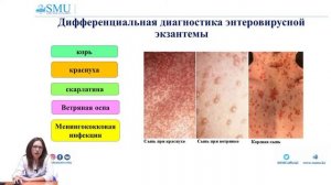 Энтеровирусная инфекция