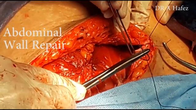 2nd Recurrent Caesarean Section Operation смотреть онлайн