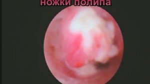 Рецидив полипов шейки матки. Радикальное удаление.