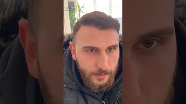 Пересадка волос после отлично результат #пересадкаволос