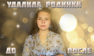 Удалила родинки на лице! До и После!