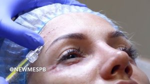 Бланшинг морщин лба с помощью филлера BELOTERO SOFT