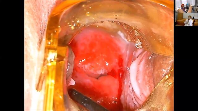 Как преодолеть сложности в прохождении цервикального канала с помощью Дилапан и Дилатор смотреть онлайн