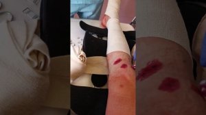 Первая перевязка после пластики ПКС