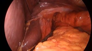 Лапароскопическая фундопликация Short Floppy Nissen (SFN)