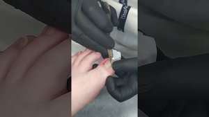 Удаление вросшего ногтя!