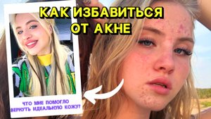 Как побороть АКНЕ?