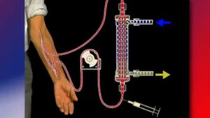 Гемодиализ, принцип, мембрана, подключения