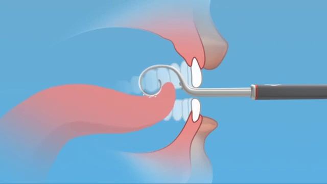 Логопед постановка звука Р импортным зондом www.zondov.ru смотреть онлайн