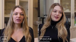 До и После! Комплексное преображение: блефаропластика, ринопластика, ментопластика