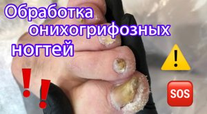 Обработка онихогрифозных ногтей ??⚠️❗️??