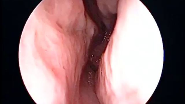 Аденоиды в 46 лет.mp4 смотреть онлайн