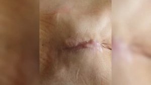 ?️ Лечение пролежней в домашних условиях. Отзыв. Врач хирург Гармаев Александр Шагжиевич