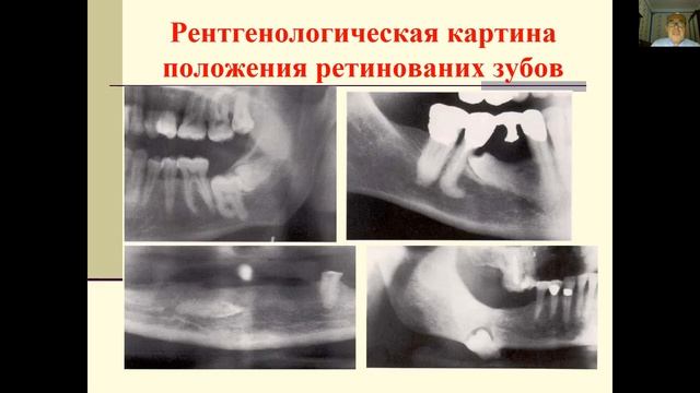 Патология прорезывания зубов Местные и обшие факторы влияюшщие на прорезывания зуба смотреть онлайн