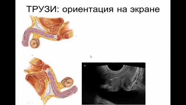 Ультразвуковая анатомия предстательной железы.Видеолекция смотреть онлайн