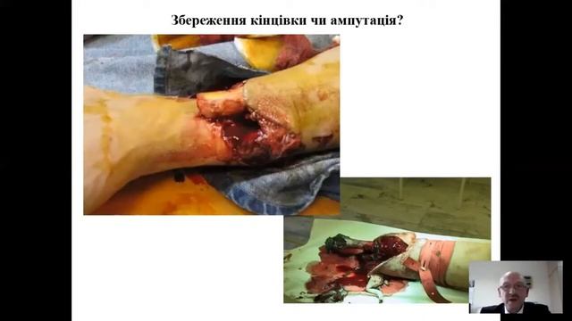 Ампутації нижньої кінцівки у травматологічних пацієнтів смотреть онлайн