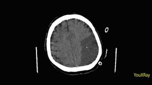 Ишемический инсульт на КТ и гипоксико-ишемическое повреждение головного мозга