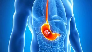 Рак желудка первые симптомы