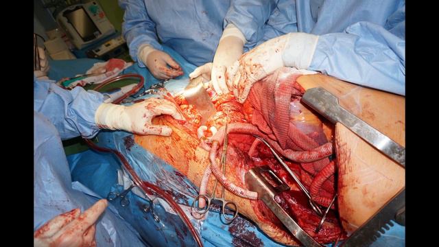 thoracoabdominal aneurysm