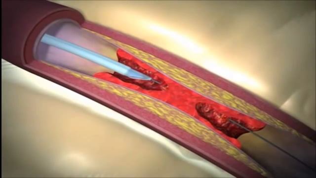 Тромбоэктомия с помощью аспирационного катетера смотреть онлайн