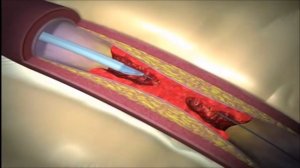 Тромбоэктомия с помощью аспирационного катетера