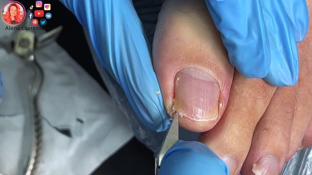 Врастают ногти на ногах / Ноготь склонный к врастанию смотреть онлайн