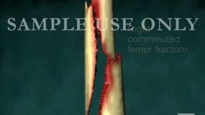 Осколочный перелом правого бедра