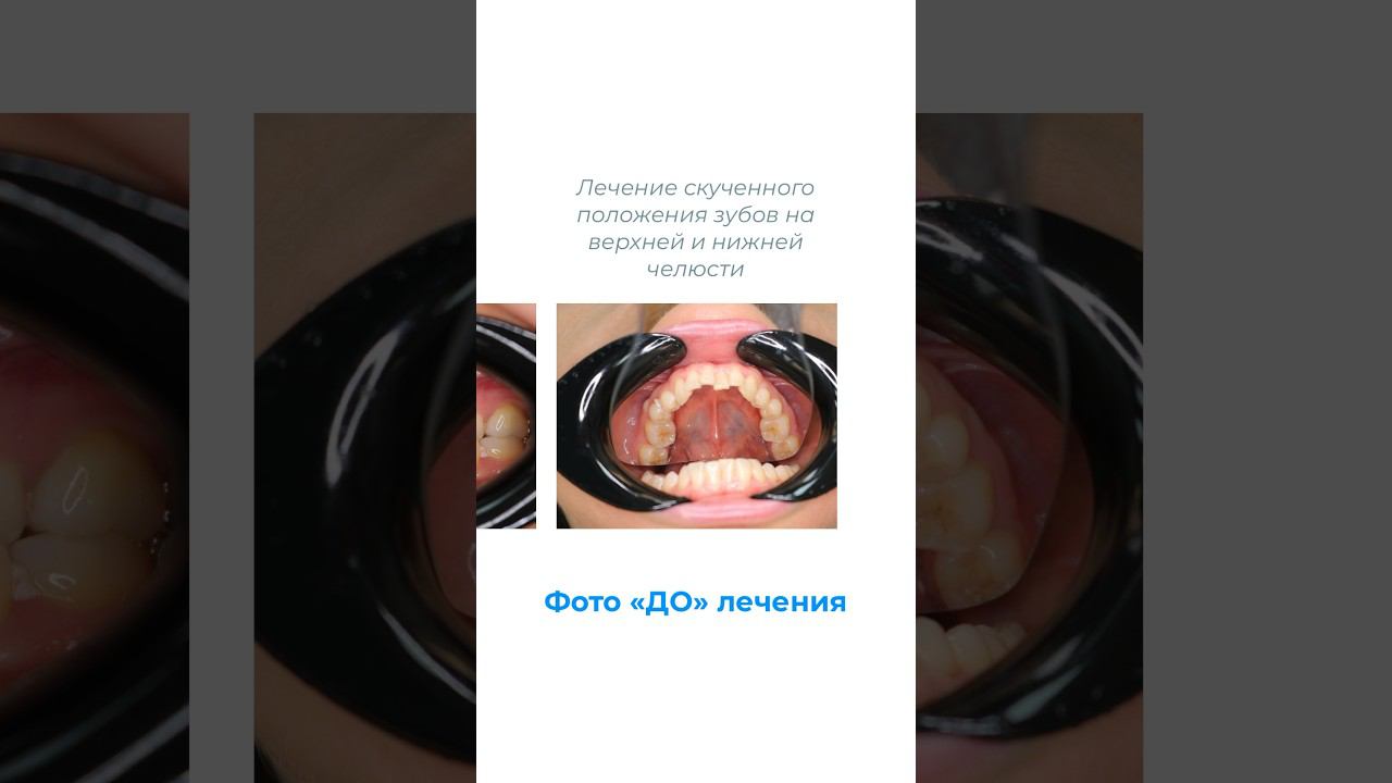 Исправление прикуса. Бесплатная консультация   +7(495)108-11-49 #москва #ортодонтия #лечениезубов