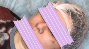 Нити. Коррекция малярных мешков. Процесс?