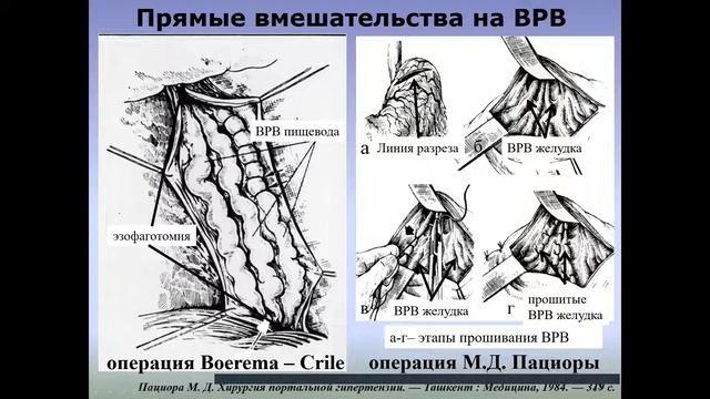Лекция: портальная гипертензия