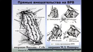 Лекция: портальная гипертензия